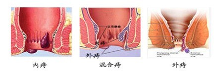 痔疮图片